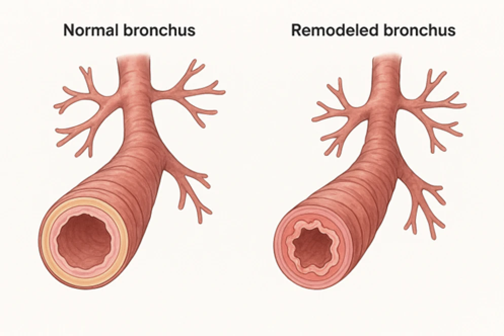 Q：気管支の状態が悪いとどうなりますか？
