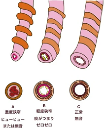 Q：気管支の状態にはどんな種類がありますか？